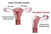  Một trường hợp thai làm tổ ngoài tử cung 