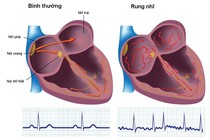 Bác sĩ chỉ rõ lý do rung nhĩ gây đột quỵ não, nhồi máu cơ tim