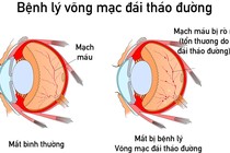 Nguy cơ mù lòa do biến chứng của bệnh đái tháo đường