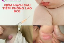 Bác sĩ chỉ cách xử trí viêm hạch sau tiêm phòng vắc xin lao