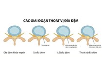 Giải ép thần kinh tránh tàn phế cho người thoát vị địa đệm