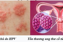 Chuyên gia mách cách phòng ngừa virus HPV gây nhiều bệnh ung thư ở người