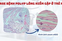 Trẻ vừa sinh xuất hiện suy hô hấp do khối Polyp lông