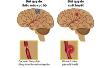 Bác sĩ mách cách tránh đột quỵ khi thời tiết chuyển lạnh