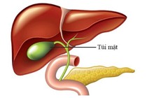 Bị sỏi túi mật không điều trị cụ bà 75 tuổi bị hội chứng Mirizzi