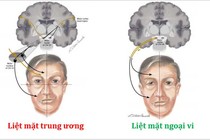 Mới 2 tuổi đã bị liệt mặt vì sự chủ quan với thời tiết lạnh