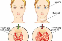 Basedow xuất hiện sau stress có thể tự khỏi