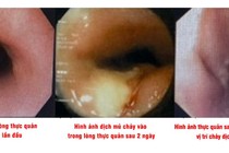 Hy hữu: Đau ngực do xương cá xuyên từ lòng thực quản tạo ổ áp xe