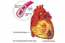 Nhiều người bị biến chứng tim mạch nặng mà không biết: phòng ngừa cách nào?