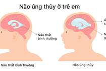 Hầu hết các trường hợp não úng thủy có thể điều trị?