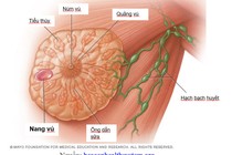 Bác sĩ chỉ rõ chuyện gì sẽ xảy ra nếu không điều trị nang vú