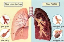 Cách chữa trị loại bệnh phổi gây tử vong thứ 3 nhưng ít người hiểu rõ