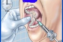 Đi chữa răng bị kim gây tê gãy lọt sâu vào mô mềm