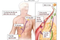 Chuyên gia chỉ rõ cách phát hiện và điều trị ung thư di căn