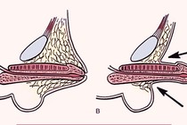 Bác sĩ mách cách phát hiện và điều trị vùi dương vật bẩm sinh ở trẻ