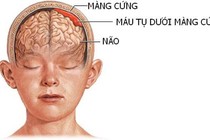 Sau tai nạn giao thông 2 tháng mới phát hiện tụ máu dưới màng cứng 