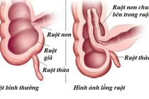 Bác sĩ chỉ cách chăm sóc trẻ tháo lồng ruột bằng hơi tại nhà