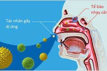 Bác sĩ chỉ rõ dấu hiệu viêm mũi tránh nhầm cảm cúm và cách chữa