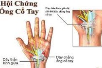 Cách chữa đau, tê, cứng cổ tay