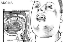 Tự chữa đau răng người đàn ông suýt tử vong vì viêm tấy sàn miệng 