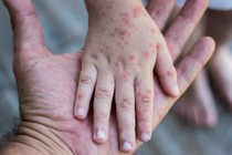 Hà Nội: Ca mắc rubella đầu tiên đã tiêm 2 mũi vắc xin phòng bệnh