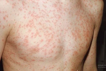 Nhiễm sởi, rubella... cẩn thận di chứng nặng suốt đời