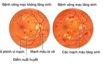 Bong võng mạc đái tháo đường 