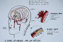 Bác sĩ chỉ rõ những rủi ro xảy ra đột quỵ ở người trẻ