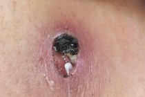 Giun rồng 1 mét chui ra từ người đàn ông 44 tuổi, cách phòng bệnh