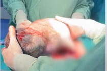 Hy hữu, em bé chào đời vẫn nằm nguyên trong túi ối