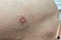 Phát hiện ca bệnh giun rồng tại Phú Thọ