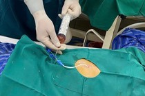 Cứu sống cụ ông 71 tuổi bị tràn dịch màng ngoài tim do lao