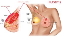  Viêm tuyến vú ở phụ nữ có thể gây biến chứng nguy hiểm 