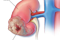 Lưu ý loạt triệu chứng ung thư thận nhiều người bỏ qua