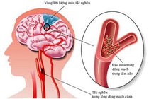 Nắng nóng 41 độ, hãy chú ý đến 7 dấu hiệu sớm của đột quỵ này để giúp bạn thoát chết 