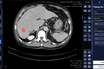 VinBrain cùng Bệnh viện Đại học Y dược phát hiện và chẩn đoán ung thư gan bằng AI
