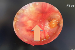 Cholesteatoma tai giữa ở trẻ em gây nhiều biến chứng nguy hiểm, phòng tránh thế nào?