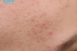 Mụn đầu trắng có tự hết không? 3 điều cần biết để trị mụn hiệu quả