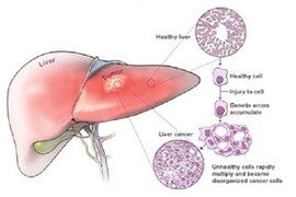 Những biểu hiện của bệnh ung thư gan 