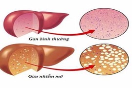 7 dấu hiệu cảnh báo gan bị nhiễm độc 