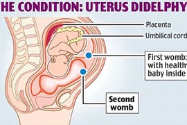 Tiết lộ về chuyện khó nói của người có tử cung kép