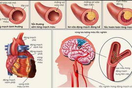 Mối liên quan giữa tăng huyết áp và rối loạn mỡ máu