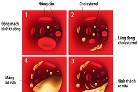 Vì sao người gầy vẫn bị rối loạn mỡ máu? 