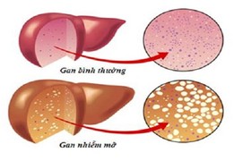 Hiểm họa đến từ gan nhiễm mỡ 