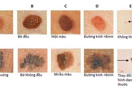 Những vị trí mọc nốt ruồi có thể tiến triển thành ung thư