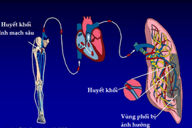 Thuyên tắc phổi suýt chết vì ôm máy tính hơn 12 giờ/ngày