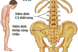 Viêm cột sống dính khớp, lúc nào cần dùng thuốc?