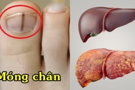 4 dấu hiệu ở bàn chân cảnh báo chức năng gan suy giảm