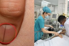 5 dấu hiệu bất thường ở ngón tay cảnh báo bệnh nguy hiểm