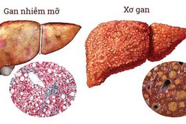 Thói quen xấu nhiều người mắc, đang bức tử lá gan của mình